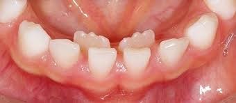 から が 見える 歯 歯茎 上の一番奥歯の歯茎から歯石が・・・