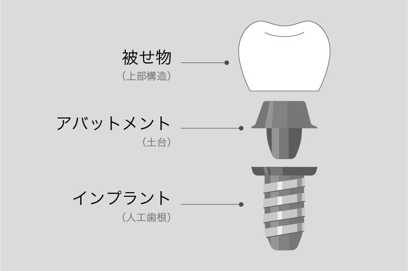 インプラント治療とは？